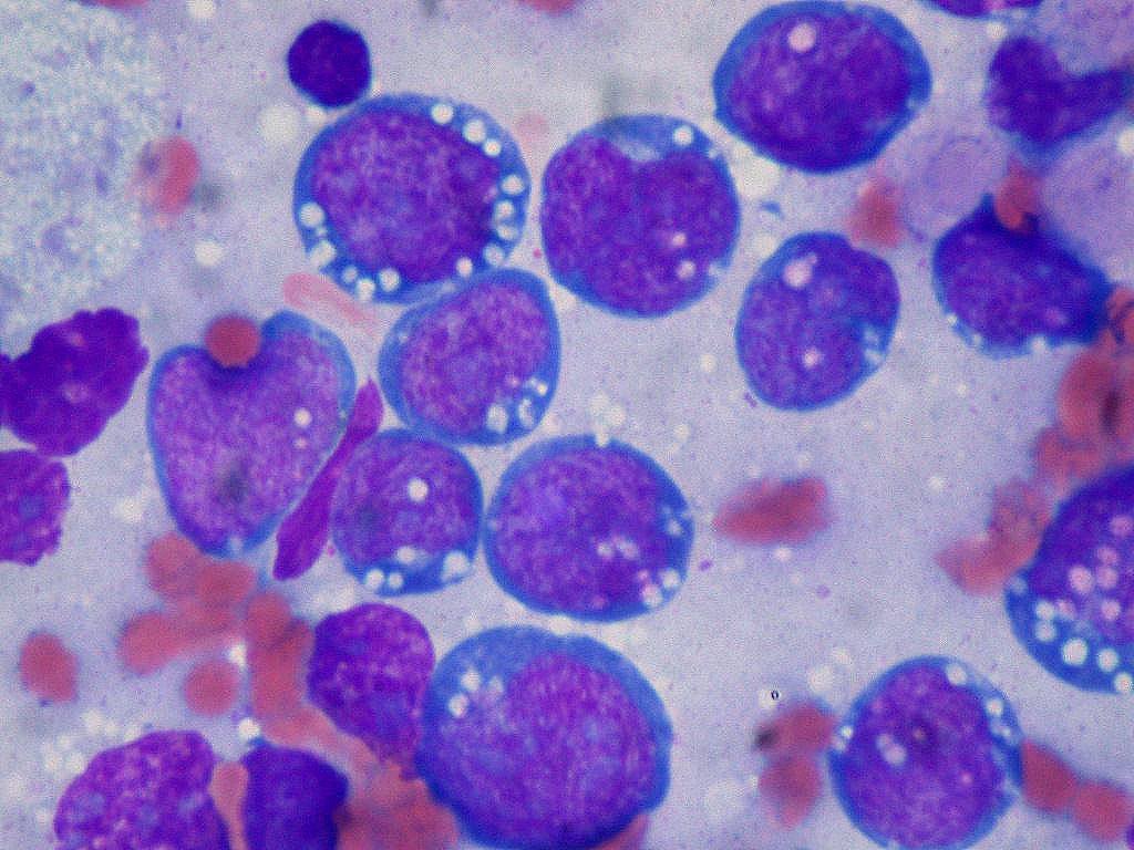 Especialistas descartan las promesas de curas dietéticas contra el cáncer y apuntan a la obesidad como factor de riesgo