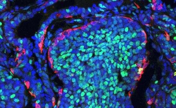 Mientras persisten brechas de acceso, Alerta de la OMS expone el costo de la desigualdad: el cáncer mata 26 mil personas al día